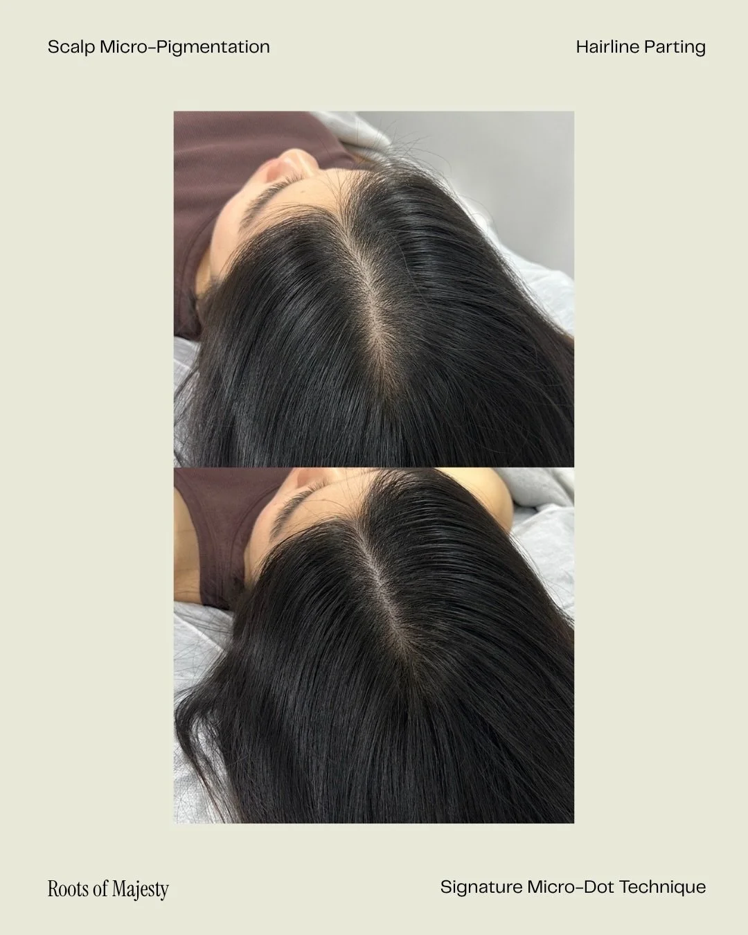 Scalp Micro-Pigmentation should not look like black dots sitting on the scalp.

When done too harshly, the result can look obvious&hellip; especially under bright lighting or when the hair is parted. 

At Roots of Majesty, we focus on soft micro-dott