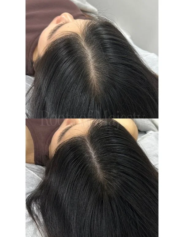 scalp micropigmentation before after widening parting Singapore women