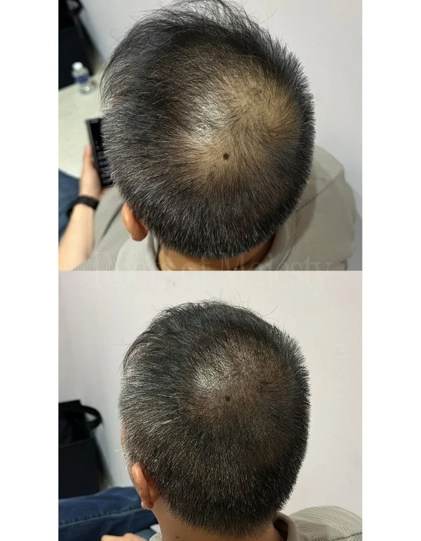 Scalp Micro Pigmentation SMP for Men Singapore Hairloss