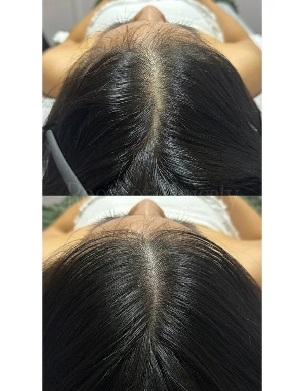 SMP Singapore Scalp Micro Pigmentation Center Parting Widening Women