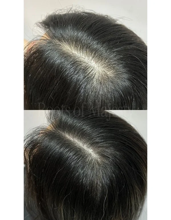 Scalp Micro Pigmentation Singapore Before After for Women