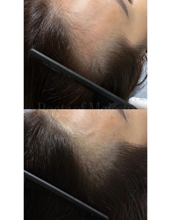 Side Hairline Micro Pigmentation For Women Singapore