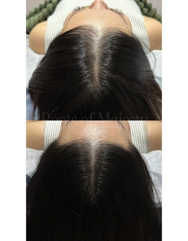 scalp micro-pigmentation female middle hair parting singapore