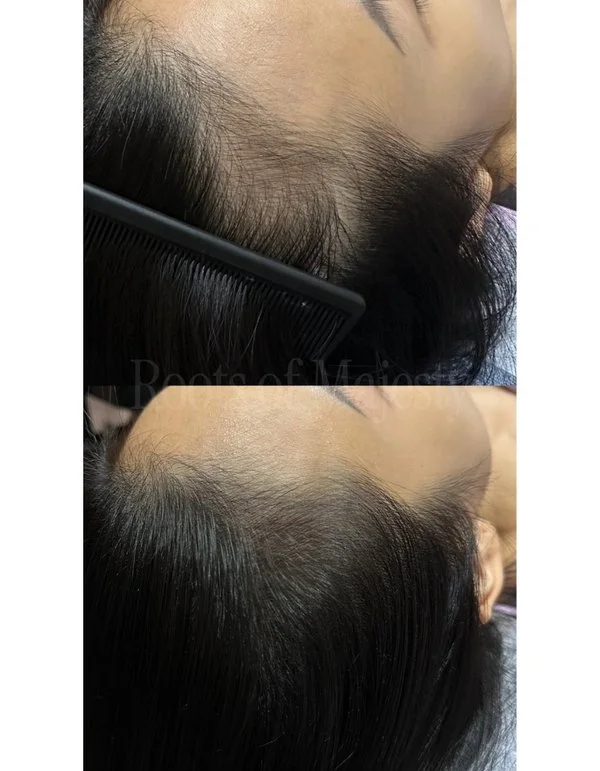 Scalp Micro Pigmentation Before After Women in Singapore Hairloss
