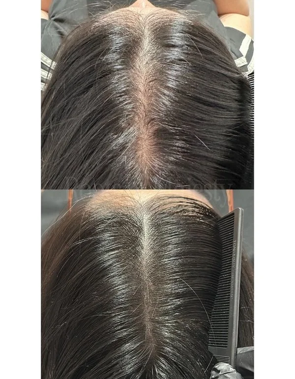 Scalp Micro Pigmentation Singapore for Women Middle Hairline