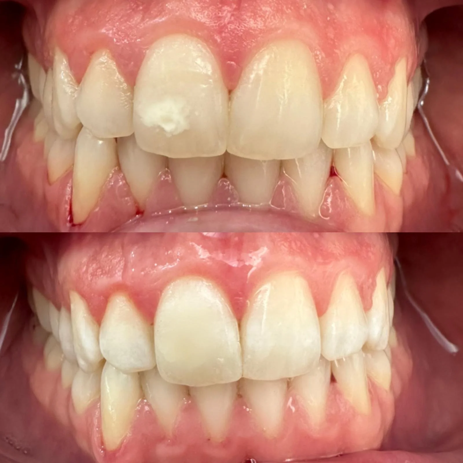 Eliminación de manchas blancas