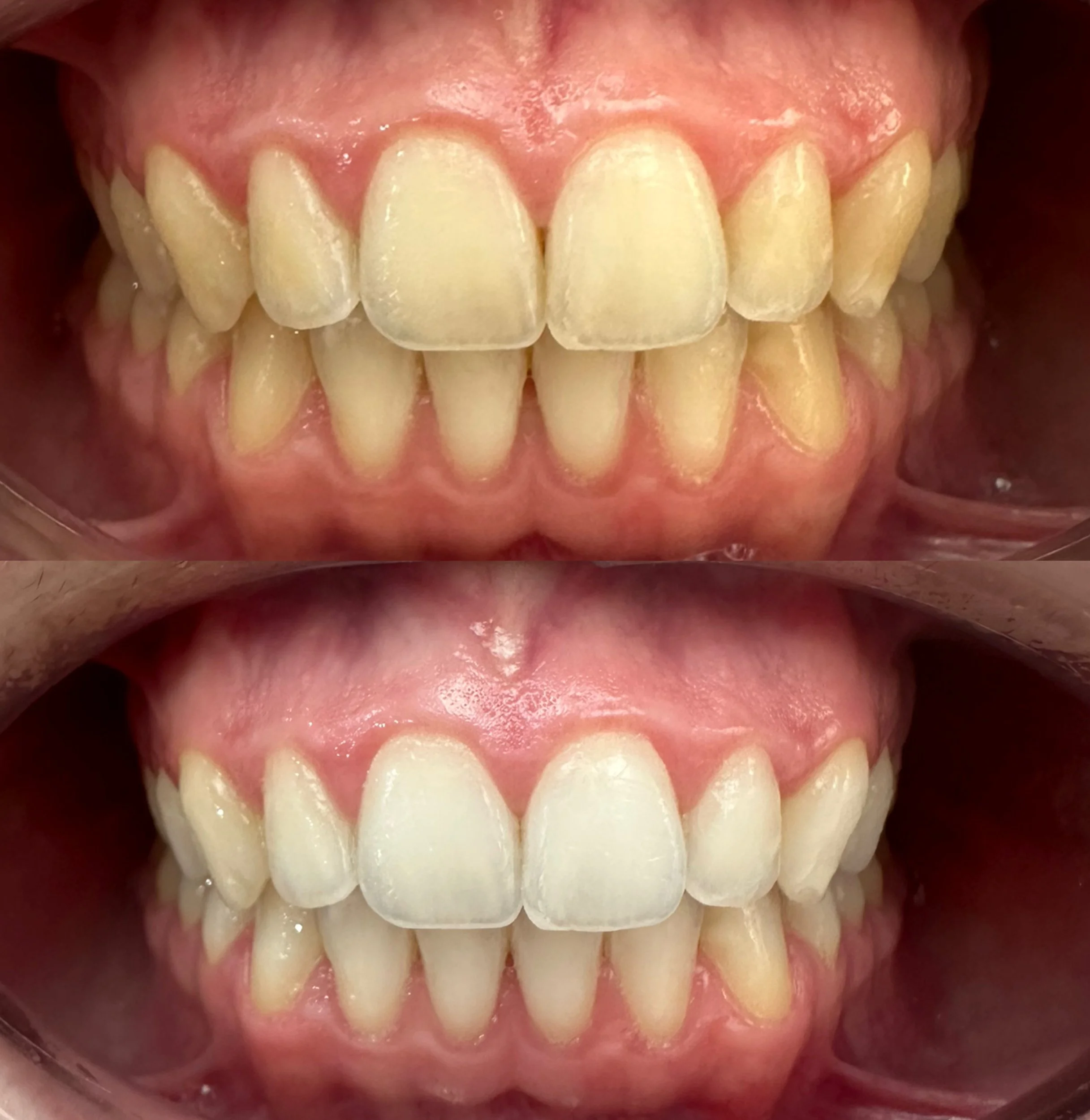 Blanqueamiento dental