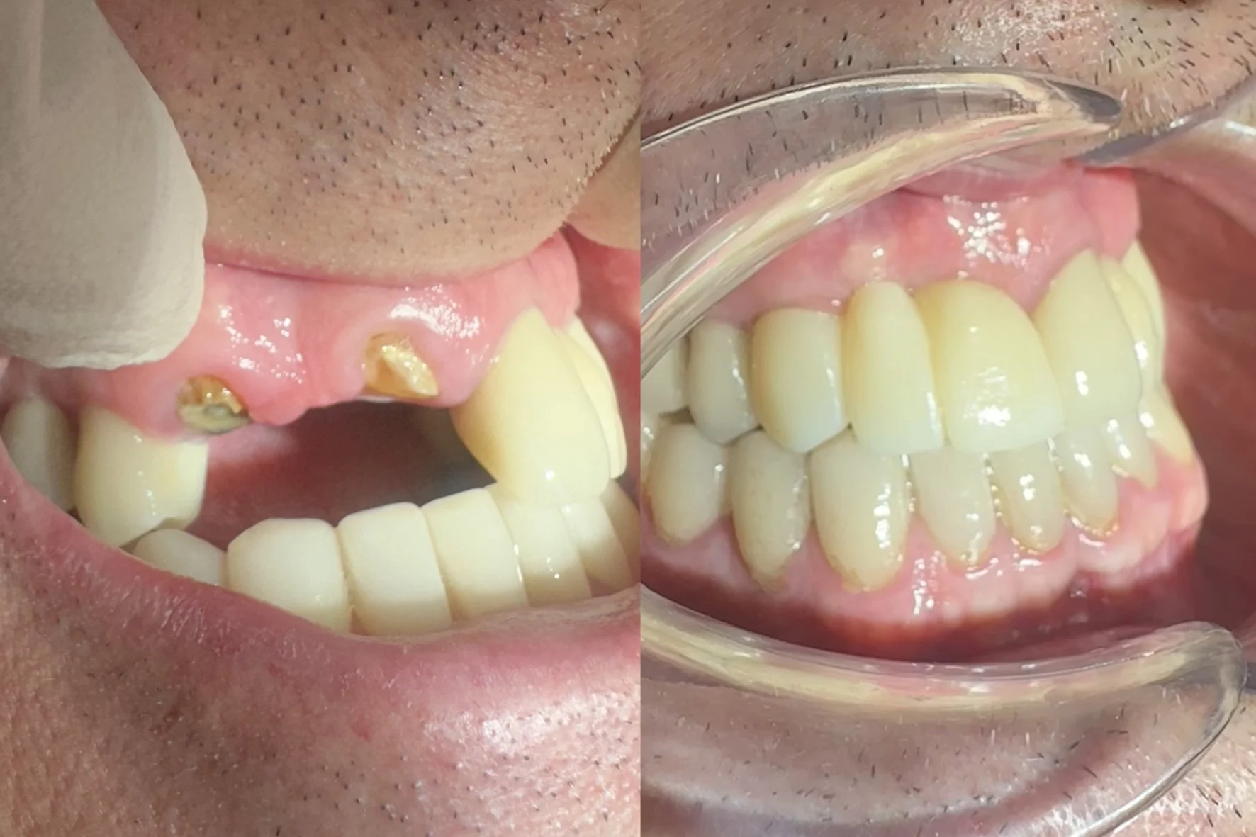 Implantes de Carga Inmediata en Clínica Dental Capitol.