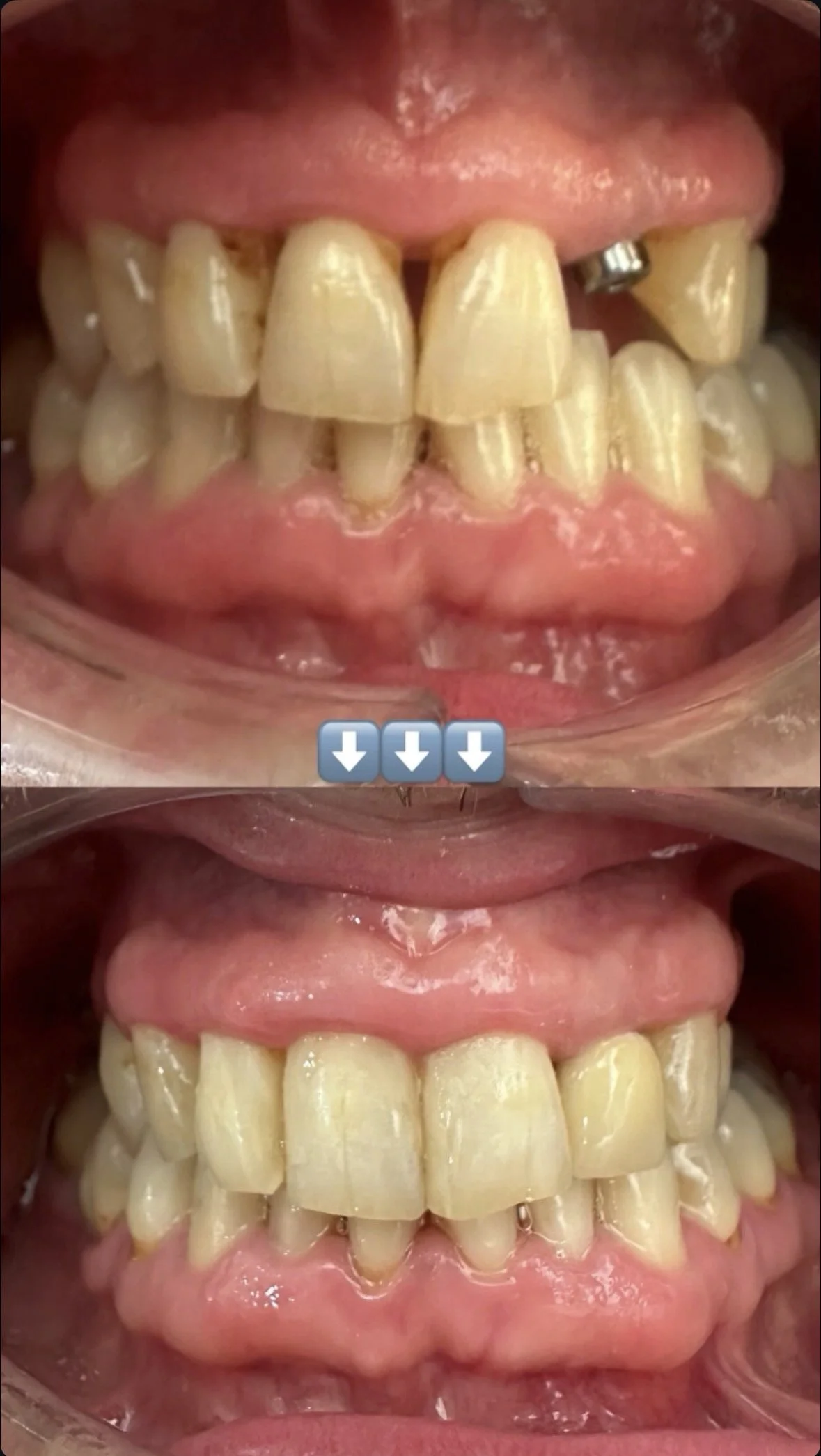 Implantes y carga inmediata