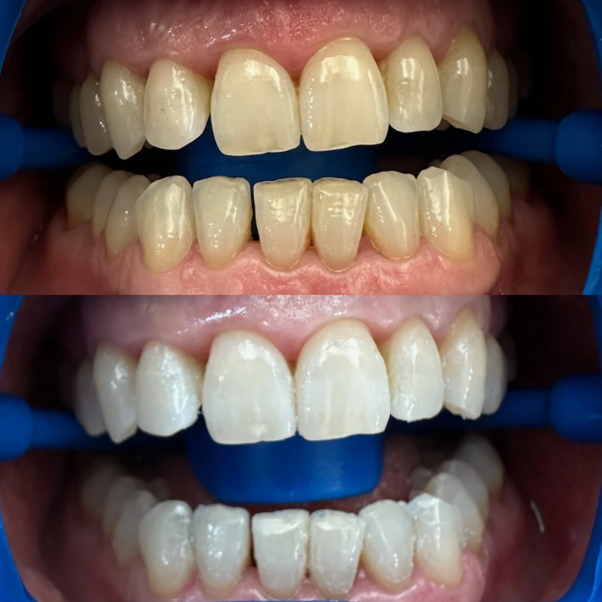 Blanqueamiento Dental en Clínica