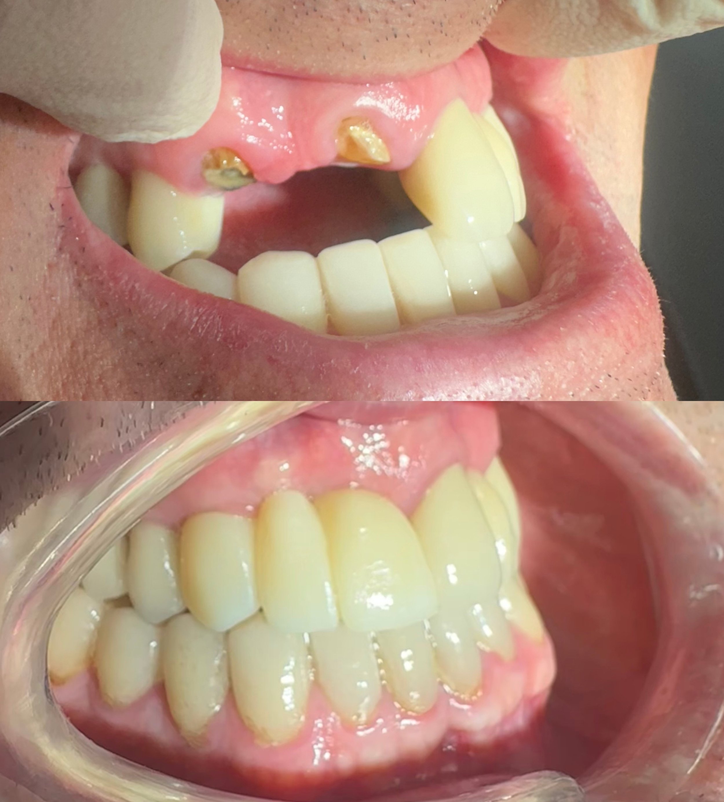 Implantología Avanzada