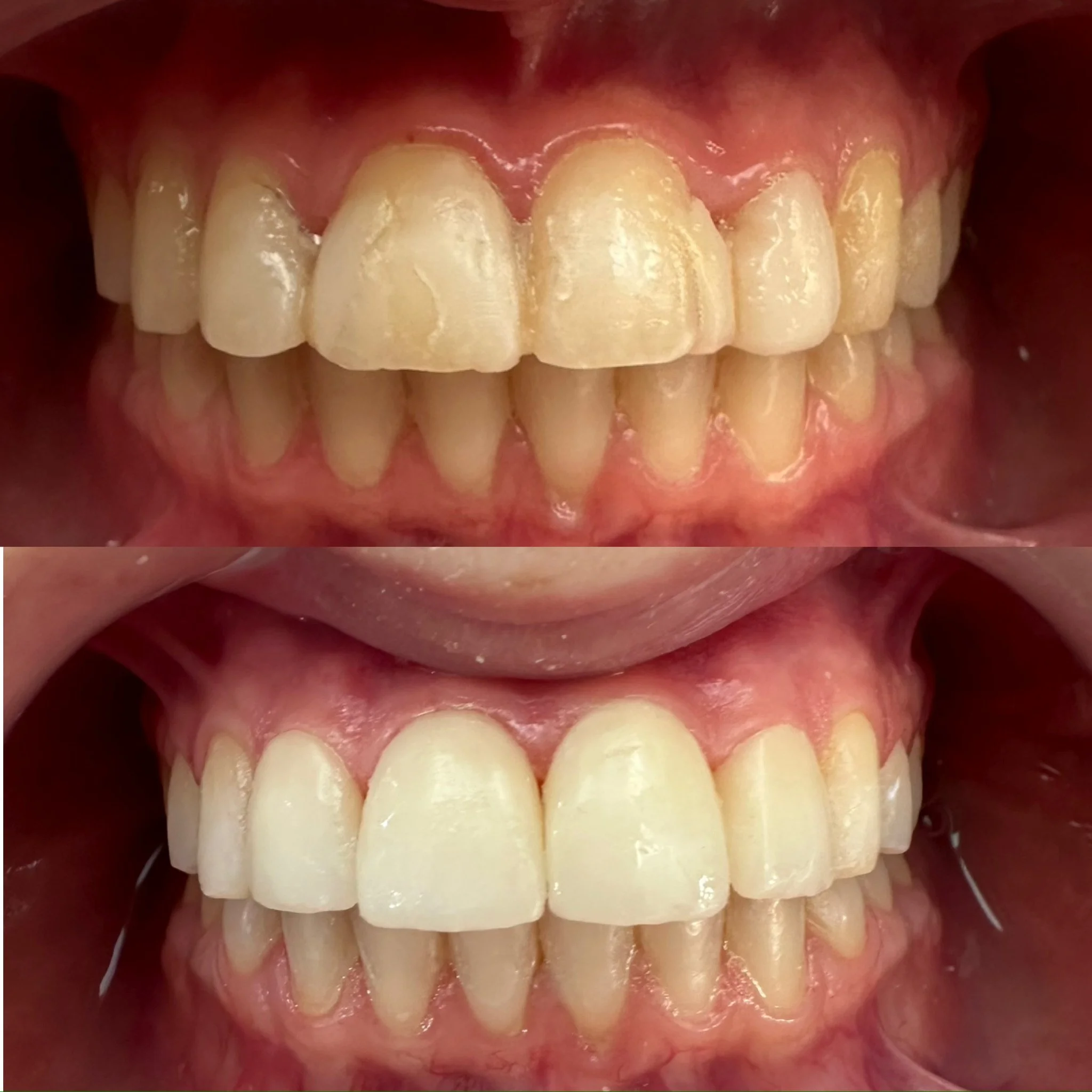 Transformación de Composite a Cerámica