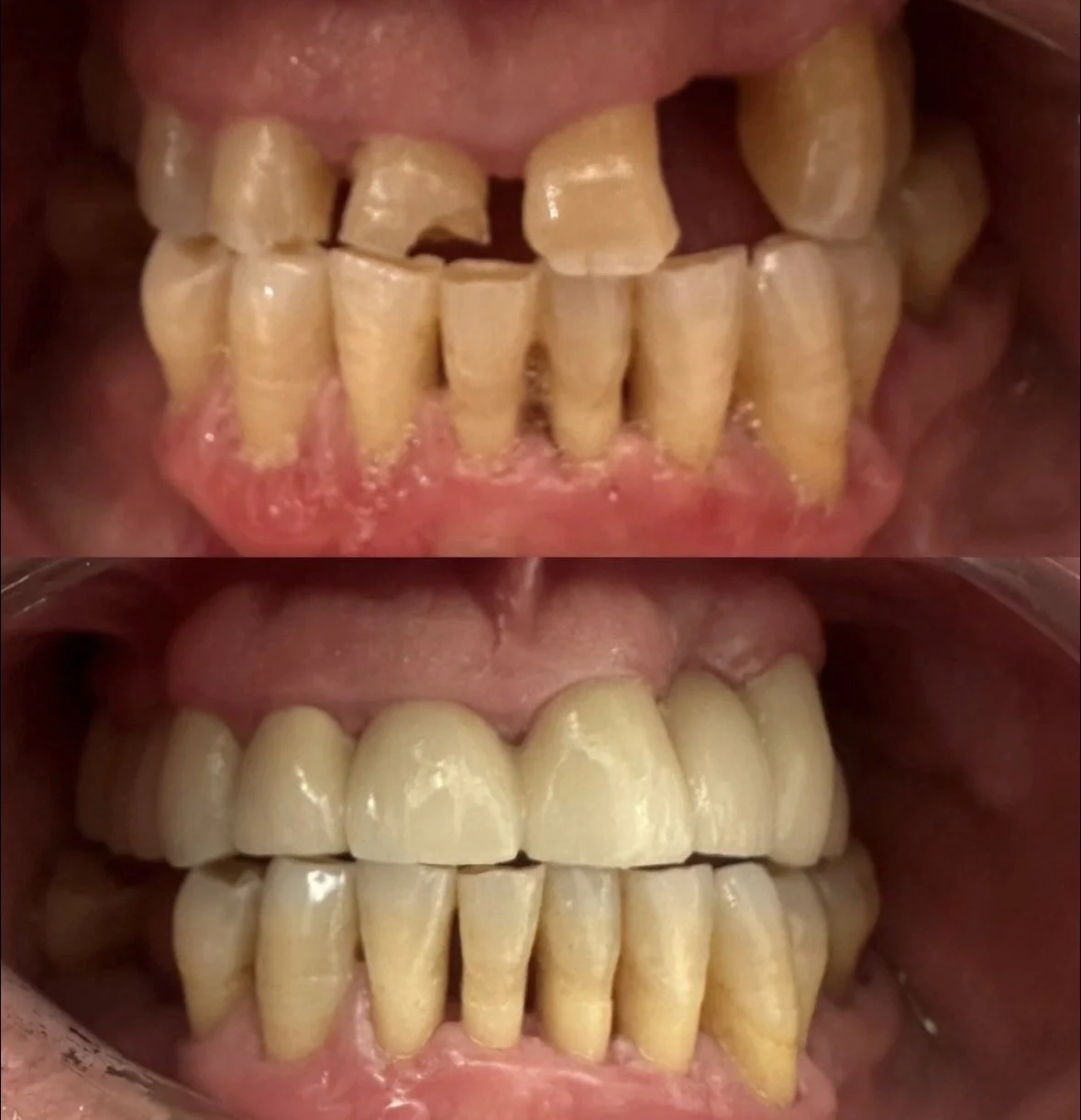 Rehabilitación completa superior