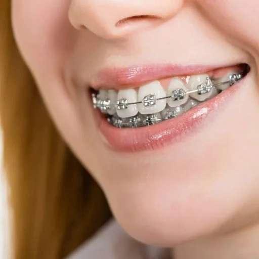 The Ultimate Parent’s Guide to Braces: When, Why, and How to Start