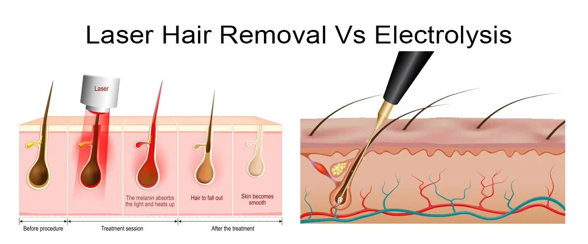 How electrolysis works