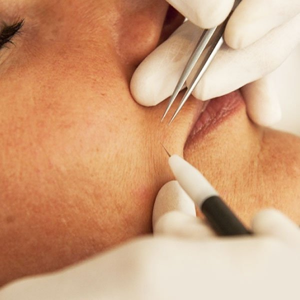 Electrolysis treatment on the face