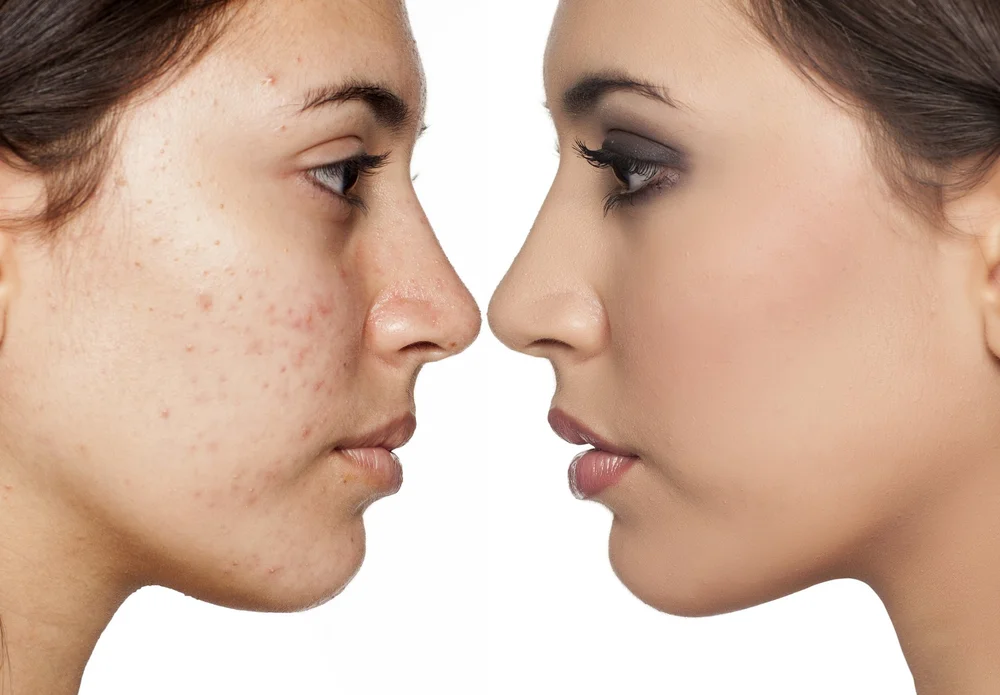 Acne facial