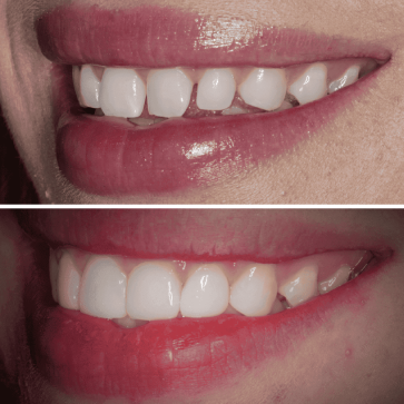 composite bonding before and after