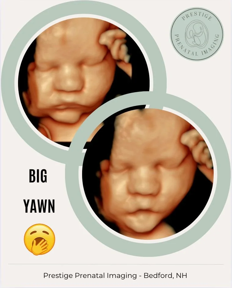 😴Baby&rsquo;s hard at work&hellip; yawning! 💛
We caught this sweet little one mid-yawn during their 4D ultrasound, and it was absolutely adorable! 
Babies actually yawn a lot on 4D, and when they give us amazing images like this, they definitely de