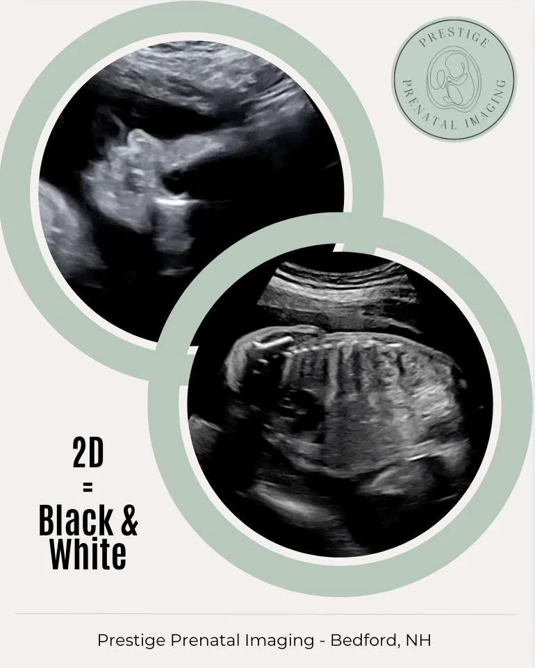 Ever wonder what the difference is between 2D, 3D, and 4D ultrasounds? Let&rsquo;s break it down! 

👶 2D Ultrasound:
This is your classic black-and-white image &mdash; perfect for checking baby&rsquo;s heartbeat, position, and movement. It&rsquo;s t
