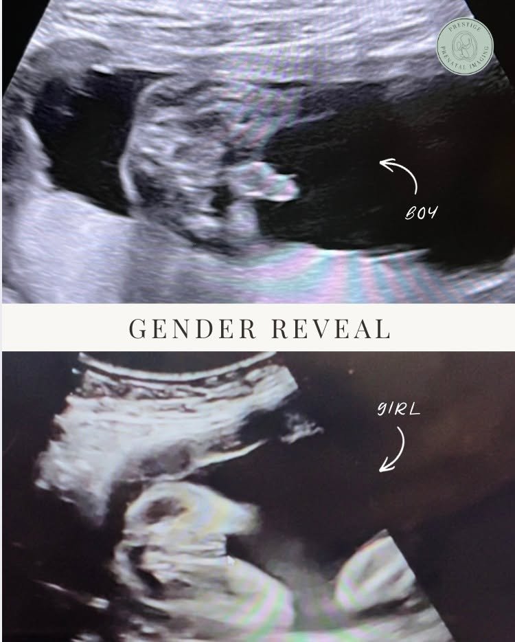 💗 Boy or Girl? 💙

Did you know ultrasound can often reveal your baby&rsquo;s gender as early as 14 weeks? ✨ This image shows the difference between what a boy vs. girl can look like during ultrasound imaging!

If you&rsquo;re too excited to wait, c
