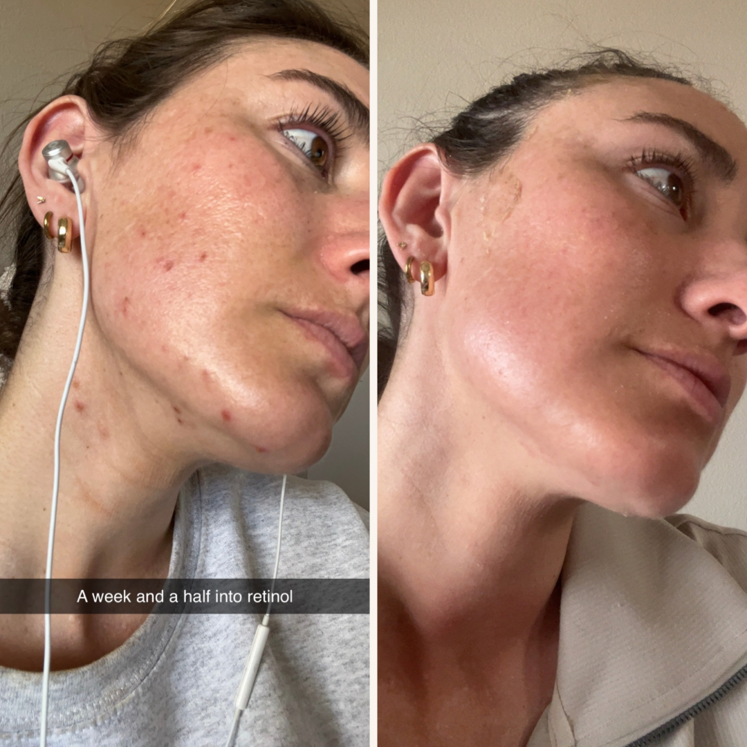 skincare retinol and treatment in denver for acne