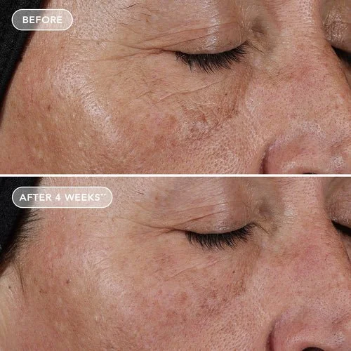AGELESS-retinol_B-A_PLR0.1_Subject4b.jpg