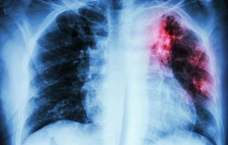 Seremi confirma caso de tuberculosis en adulto mayor de la comuna de Pinto