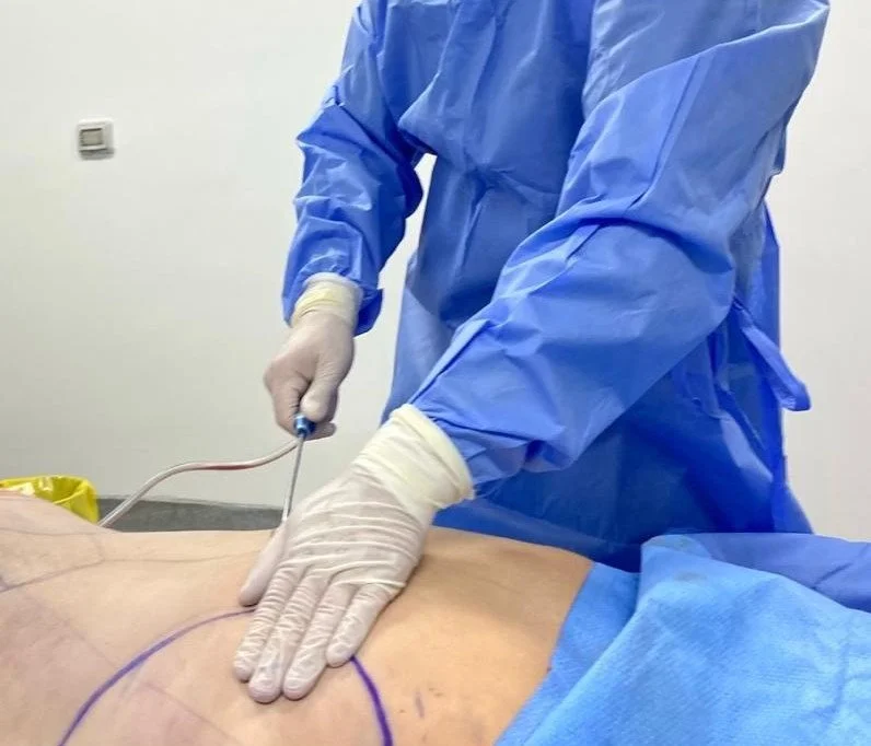 Clínica Andes Salud Chillán se posiciona como pionero en Ñuble al incorporar el PAD de Abdominoplastía