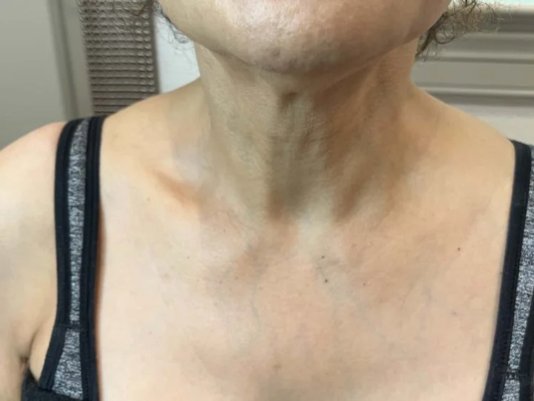 Neck after a series of Viora RF sessions