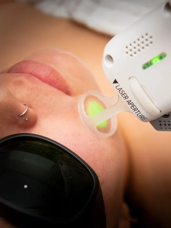 Laser skin rejuvenation with the Clarity II on the face