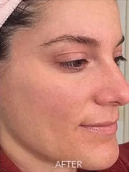 7 Days to a New You: Why The Perfect Derma Peel is the Ultimate "Reset"