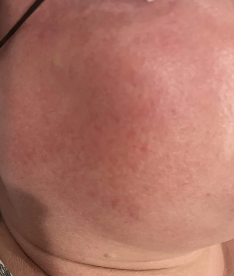 After IPL Photofacial