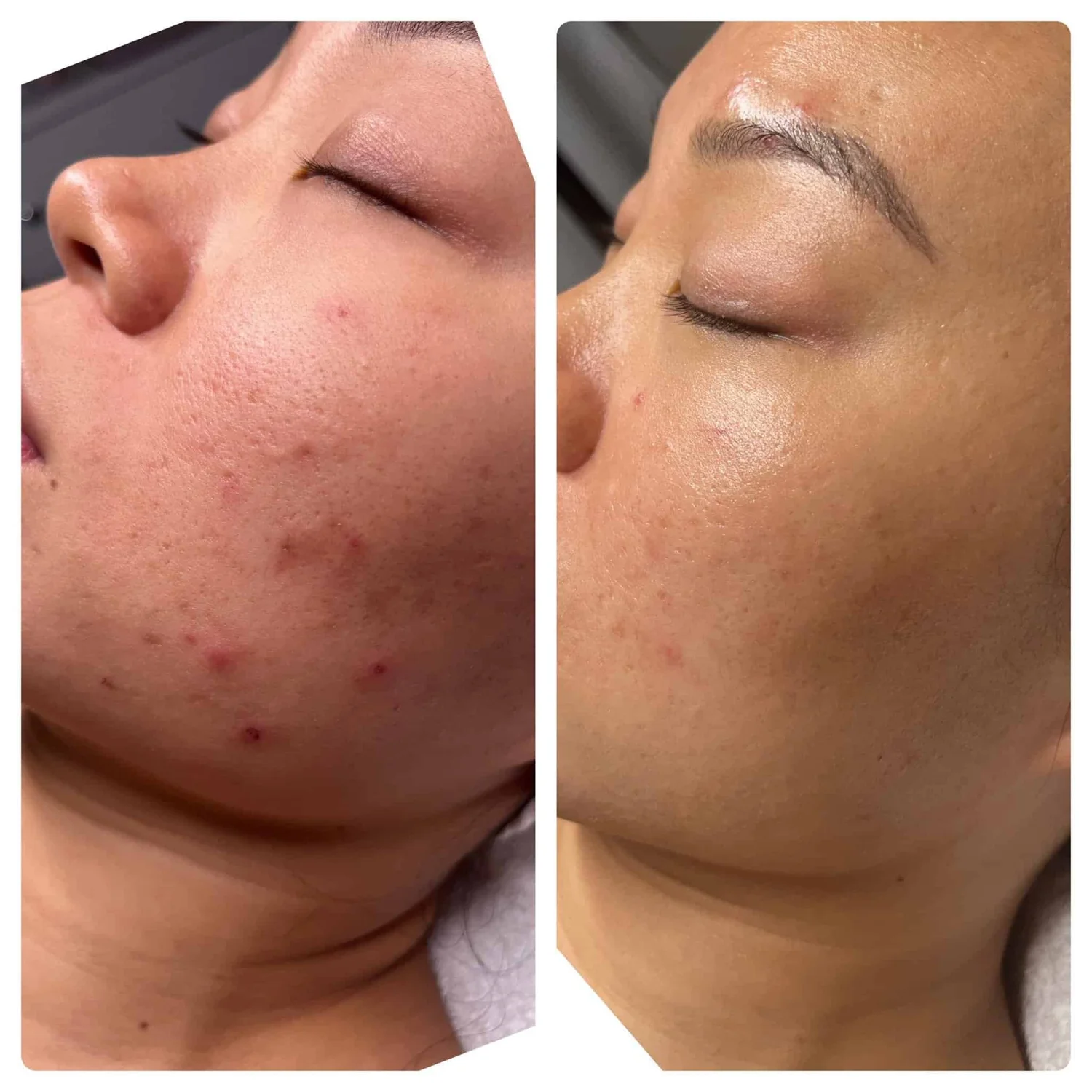 The same cheek, clearer, after the Acne Bootcamp