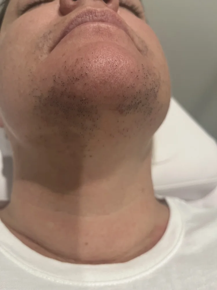 Chin before laser hair removal