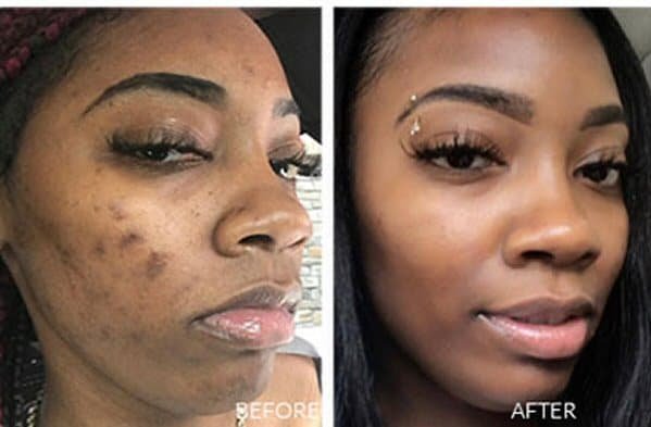 Before a Perfect Derma Peel