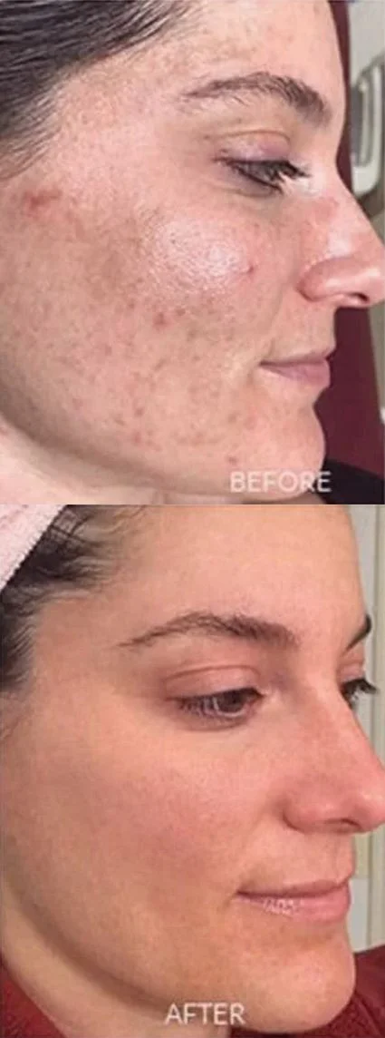 Woman showing 7-day progression of The Perfect Derma Peel, revealing glowing skin.