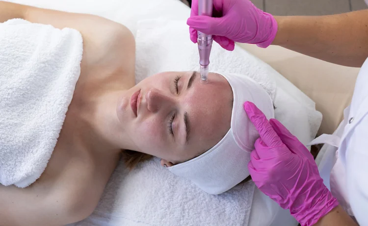 Microneedling at Tourmaline Skin Care & Laser