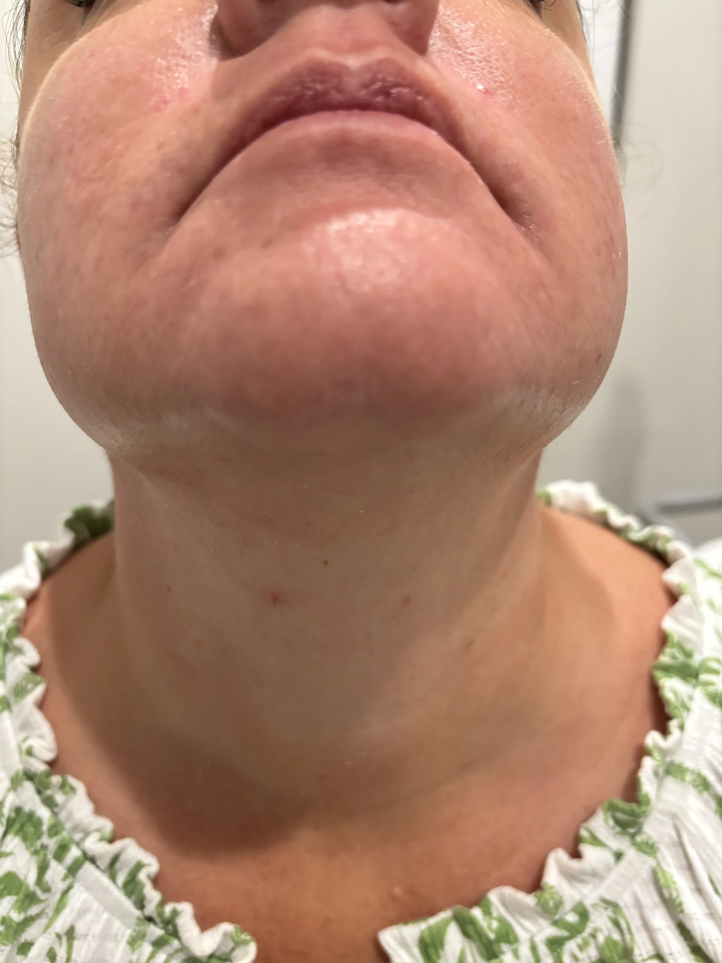 Close-up of woman's chin showing coarse stubble and unwanted facial hair before Laser Hair Removal treatment at Tourmaline Skin Care & Laser in Tomball, TX.