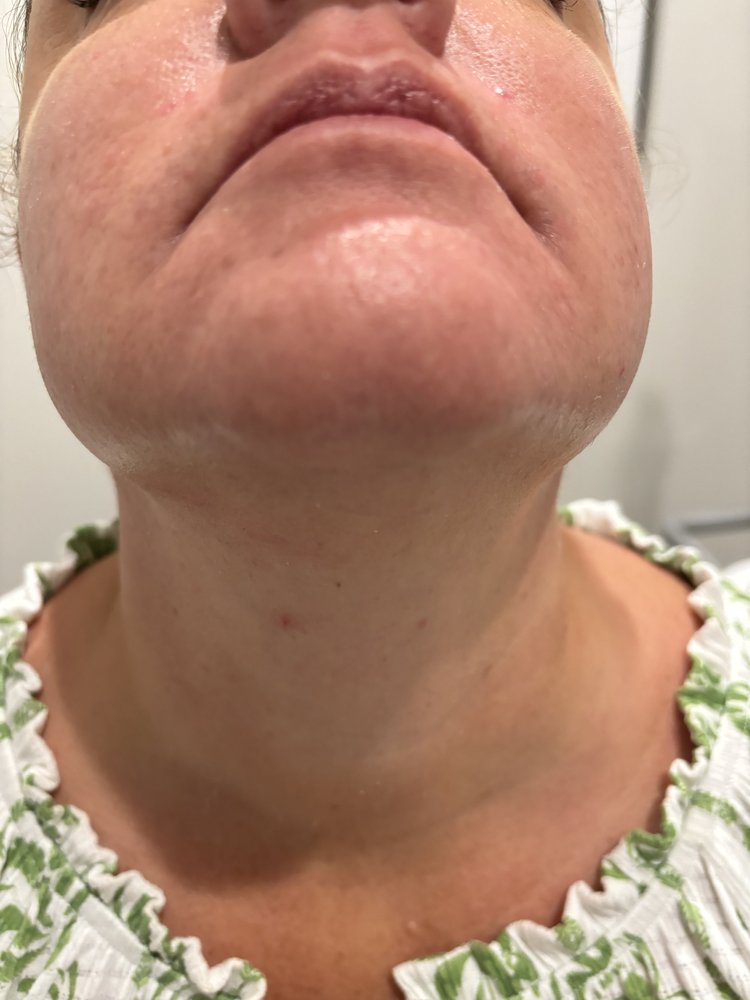 Chin after a Clarity II series