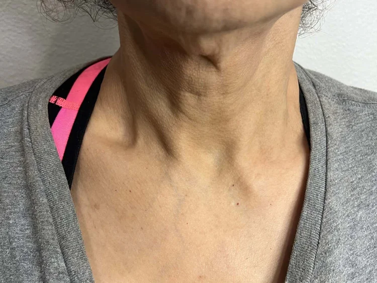 Neck before Viora RF sessions