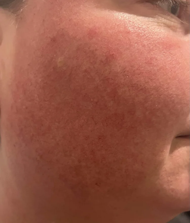 Before IPL Photofacial
