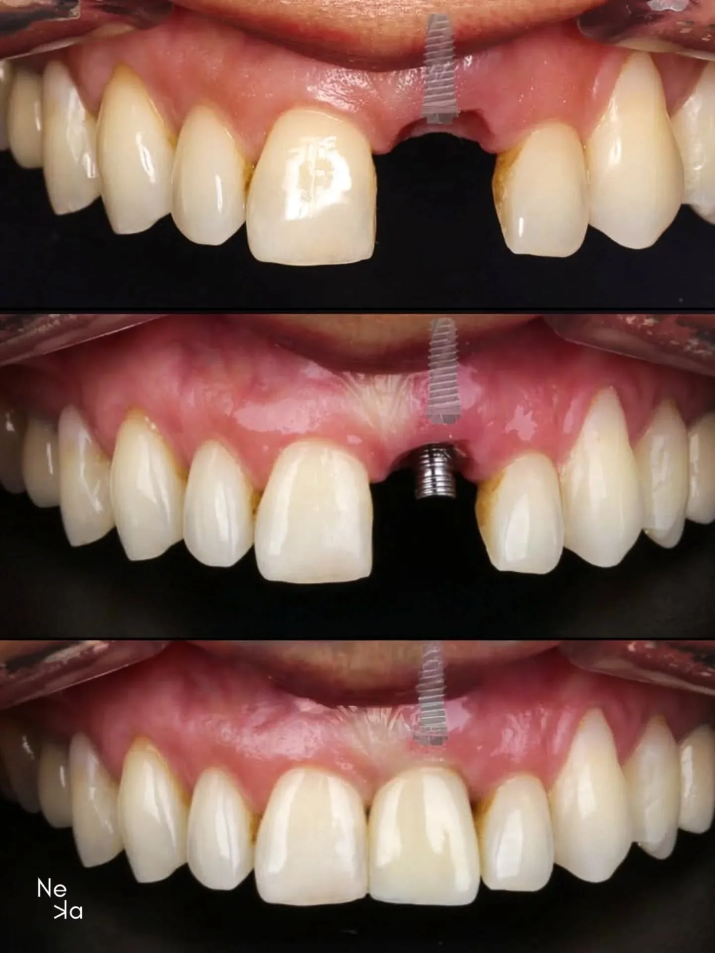 We placed an IMPLANT-SUPPORTED CROWN on a central tooth, one of the biggest challenges in dental aesthetics due to its high level of complexity. With careful attention to every detail, we achieved a natural and harmonious result. Our patient was happ