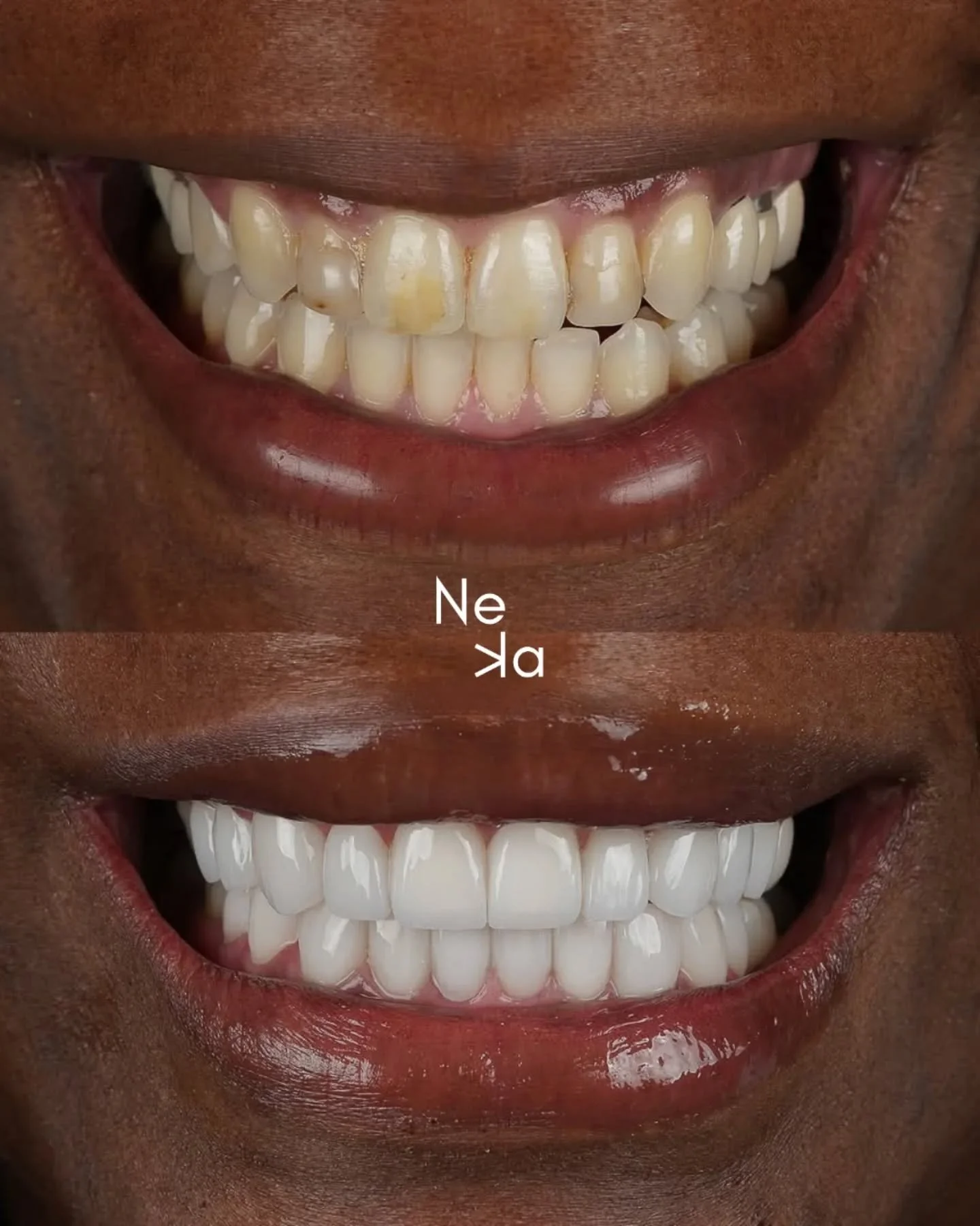 Sometimes you don&rsquo;t even need a long explanation &mdash; the results say it all.

At Neka Wellbeing, we focus on creating smiles that feel natural, confident, and truly you. Whether you&rsquo;re after a small tweak or a full makeover, we&rsquo;