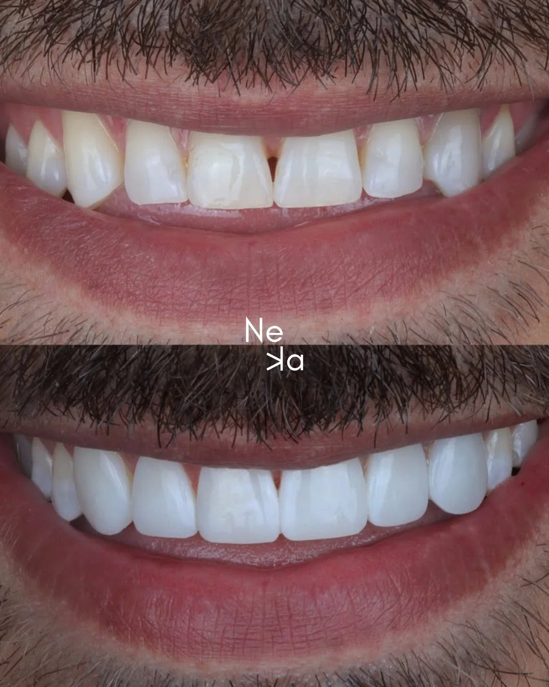 There&rsquo;s a moment when you look in the mirror and just know.
At Neka Wellbeing, we create smiles that feel as good as they look &mdash; natural, balanced, and confidence-boosting. From small enhancements to complete smile journeys, your comfort 