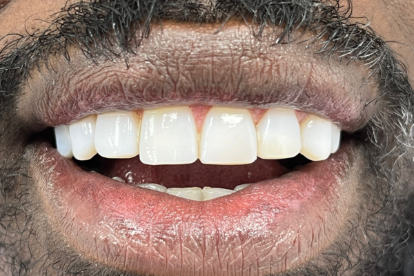 Composite Bonding
