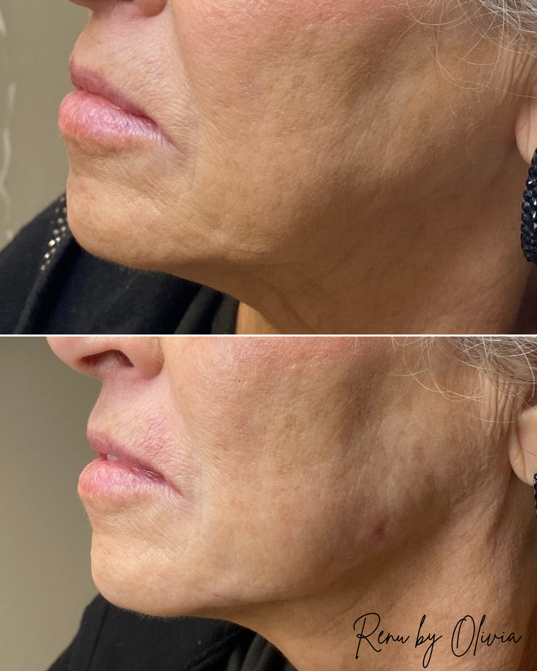 Close-up side view of a woman's lower face and jawline before and after a skincare or cosmetic treatment, showing smoother skin and reduced fine lines in the after photo.