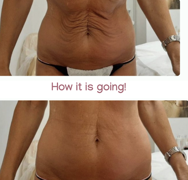 Comparison of an individual's abdominal area before (top) and after (bottom) showing improvement in skin tightness and reduction in wrinkles, with a caption that says 'How it is going!'.