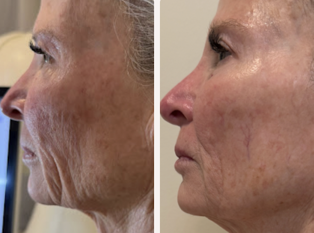 Side-by-side comparison of a woman's face before and after skin treatment, showing improved skin texture and reduced wrinkles.