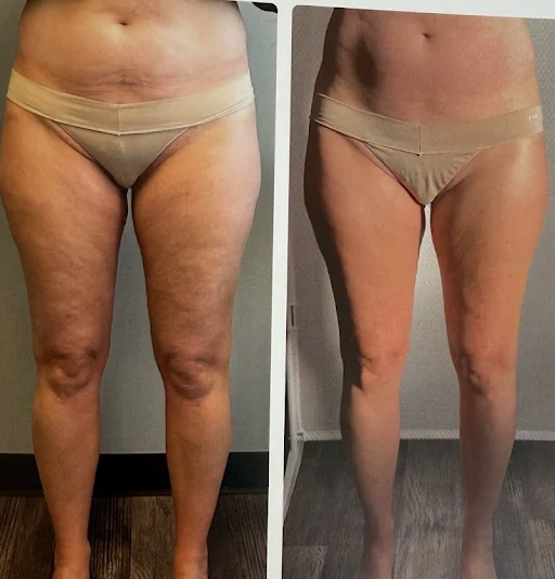 Side-by-side comparison of a woman's legs and lower torso showing before and after skin improvement, with visible reduction in skin irregularities and tightening in the second image.